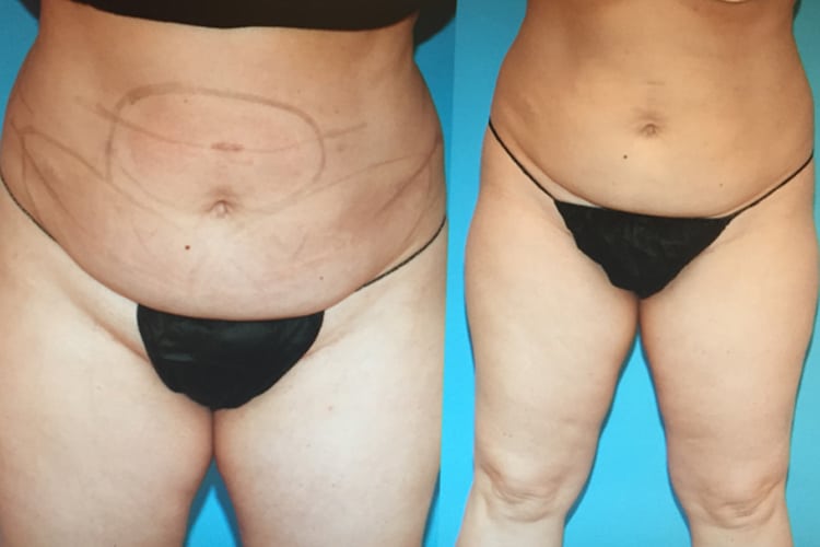 before and after coolsculpting radiance plastic surgery