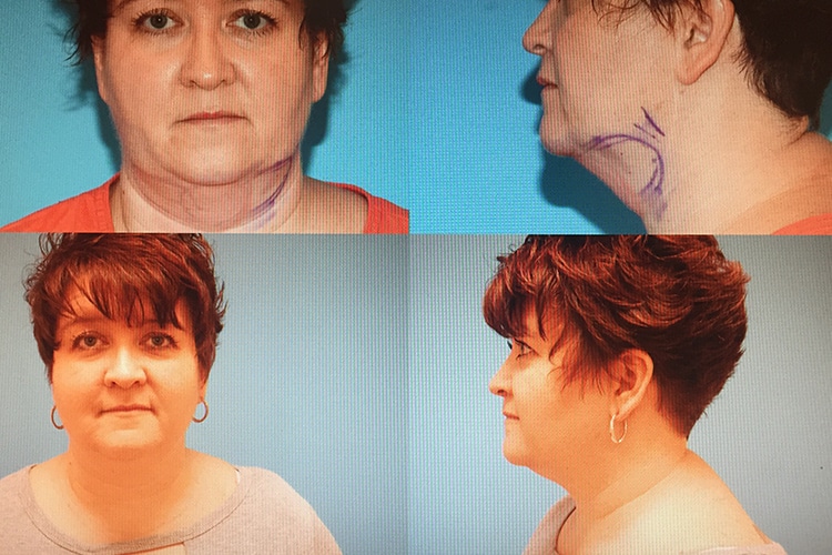 before and after coolsculpting radiance plastic surgery